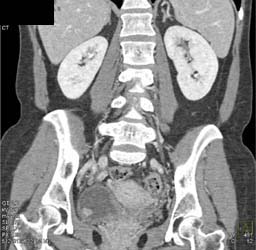 Normal CT Nephrogram - CTisus CT Scan