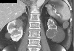 Cystic Renal Cell Carcinoma (RCC) - CTisus CT Scan