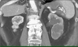 Transitional Cell Cancer (TCC) in Left Ureter - CTisus CT Scan