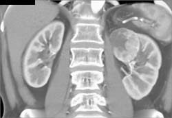 Renal Cell Carcinoma - CTisus CT Scan