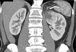 Renal Cell Carcinoma - CTisus CT Scan