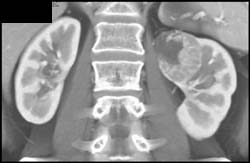 Renal Cell Carcinoma - CTisus CT Scan