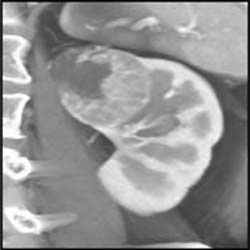 Renal Cell Carcinoma - CTisus CT Scan