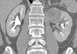 Renal Cell Carcinoma - CTisus CT Scan