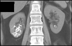 Post Embolization Arteriovenous Malformation (AVM) of Right Kidney - CTisus CT Scan