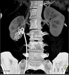 Arteriovenous Malformation (AVM) Right Kidney S/P Embolization - CTisus CT Scan