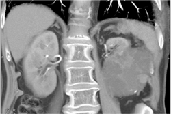 Cystic Renal Cell Carcinoma - CTisus CT Scan