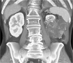 Cystic Renal Cell Carcinoma - CTisus CT Scan