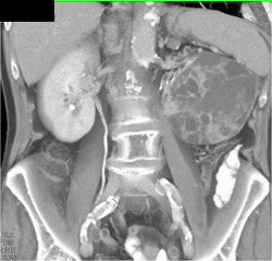 Cystic Renal Cell Carcinoma - CTisus CT Scan