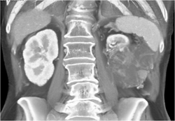 Cystic Renal Cell Carcinoma - CTisus CT Scan