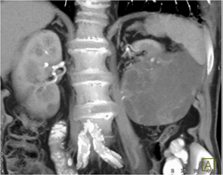 Cystic Renal Cell Carcinoma - CTisus CT Scan