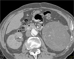 Cystic Renal Cell Carcinoma - CTisus CT Scan