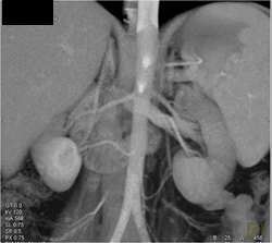 2 Renal Arteries Bilaterally - CTisus CT Scan