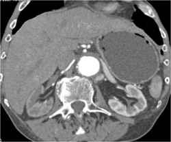 Delayed/decreased Function in Right Kidney - CTisus CT Scan