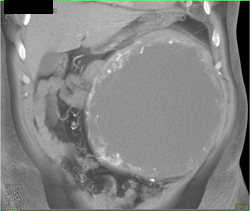 Cystic Renal Cell Carcinoma - CTisus CT Scan