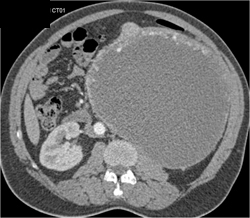 Cystic Renal Cell Carcinoma - CTisus CT Scan