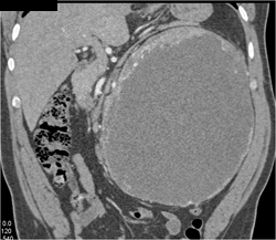 Cystic Renal Cell Carcinoma - CTisus CT Scan