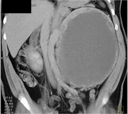 Cystic Renal Cell Carcinoma - CTisus CT Scan