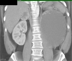 Cystic Renal Cell Carcinoma - CTisus CT Scan