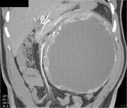 Cystic Renal Cell Carcinoma - CTisus CT Scan