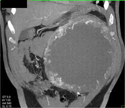 Cystic Renal Cell Carcinoma - CTisus CT Scan