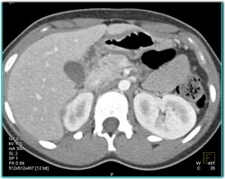 Acute Pyelonephritis - CTisus CT Scan