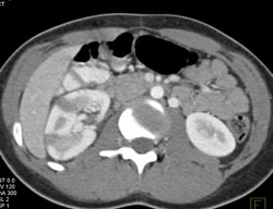 Acute Pyelonephritis - CTisus CT Scan