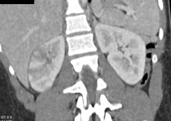 Acute Pyelonephritis - CTisus CT Scan