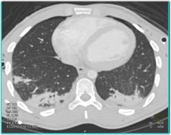 Renal Laceration - CTisus CT Scan