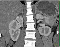 Renal Laceration - CTisus CT Scan