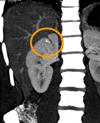 Renal Laceration - CTisus CT Scan