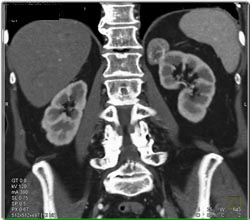 Mass Upper Pole Kidney - CTisus CT Scan