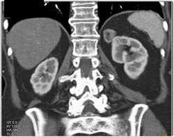 Renal Cell Carcinoma - CTisus CT Scan