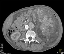 Unusual Renal Cell Carcinoma - CTisus CT Scan