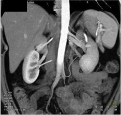 2 Left Renal Arteries - CTisus CT Scan