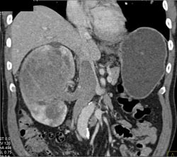 Right Ureteropelvic Junction (UPJ) Due to Crossing Lower Pole Renal Artery - CTisus CT Scan