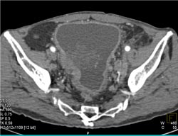 Bulky Bladder Cancer- Transitional Cell Cancer (TCC) - CTisus CT Scan