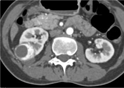 Vascular Renal Cell Carcinoma- See Sequence of Images - CTisus CT Scan