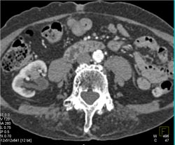 Transitional Cell Carcinoma - CTisus CT Scan