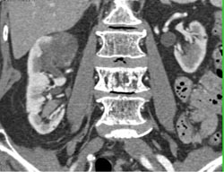 Transitional Cell Carcinoma - CTisus CT Scan