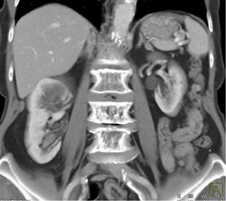 Transitional Cell Carcinoma - CTisus CT Scan