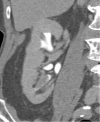 Transitional Cell Carcinoma - CTisus CT Scan