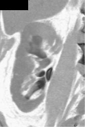 Transitional Cell Carcinoma - CTisus CT Scan