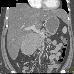 Oncocytic Renal Cell Carcinoma (RCC) Looks Like Peripancreatic Mass- Fooled Me! - CTisus CT Scan