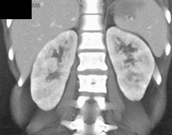 Patchy Enhancement Kidney Due to Pyelonephritis - CTisus CT Scan