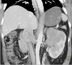 Renal Cell Cancer Invades the Renal Vein and IVC - CTisus CT Scan