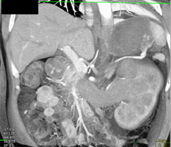 Renal Cell Carcinoma Invades the Left Renal Vein and IVC - CTisus CT Scan