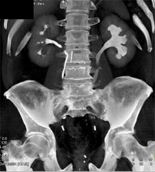 Dilated Left Ureter and Pelvis With Neobladder - CTisus CT Scan