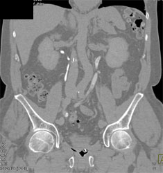 Transitional Cell Cancer (TCC) of the Left Kidney and Ureter - CTisus CT Scan