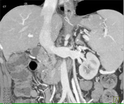 Prominent Left Gonadal Vein - CTisus CT Scan